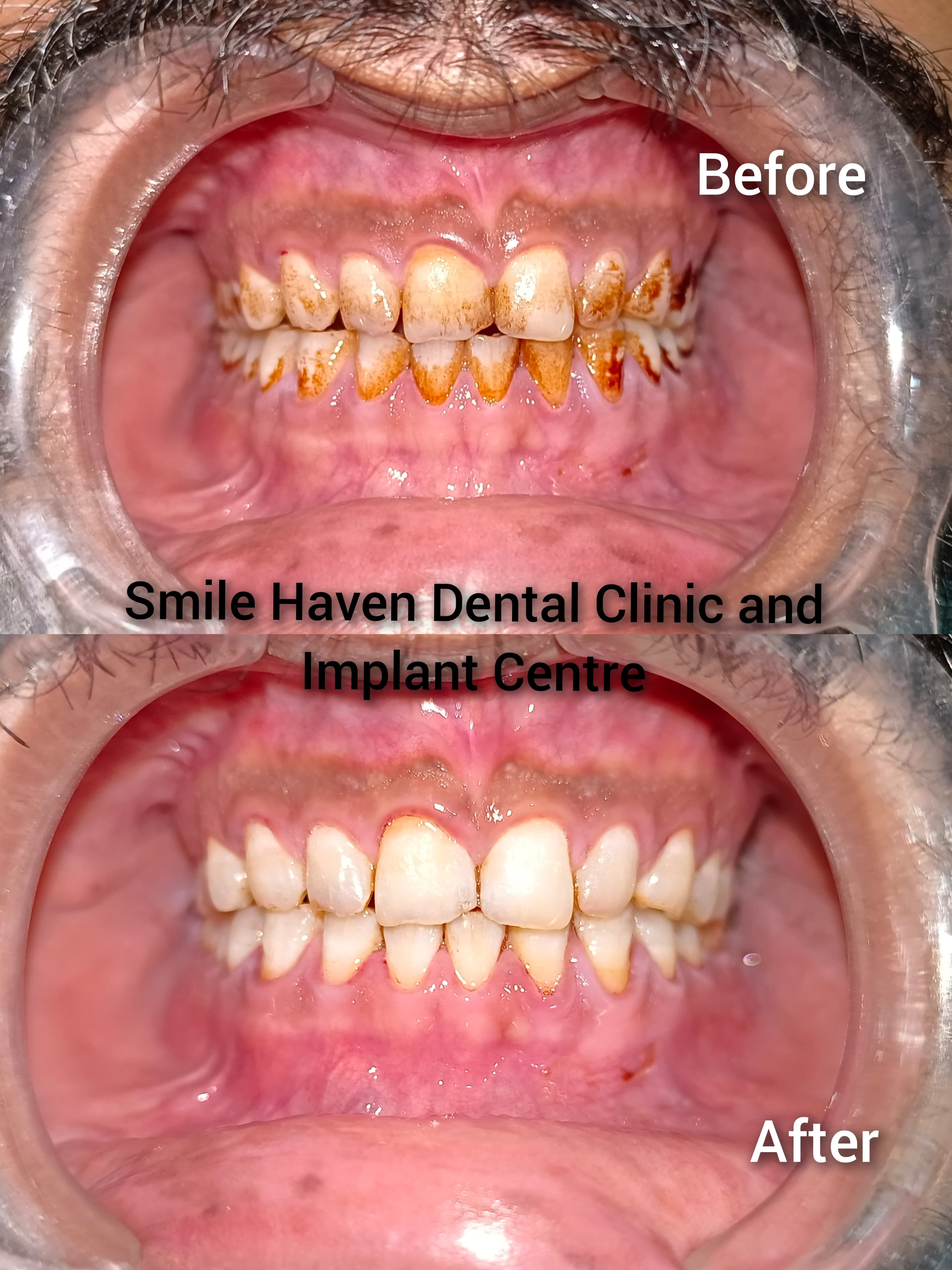 Before & After 6